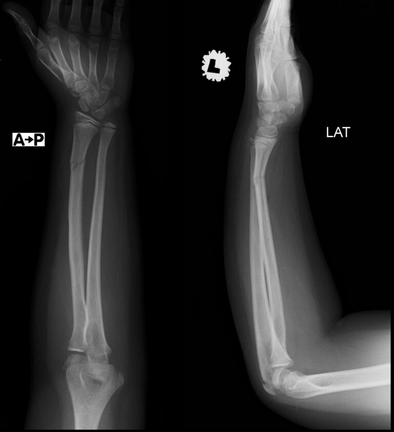 Closed Fracture Of Distal Radius Uni Clinic