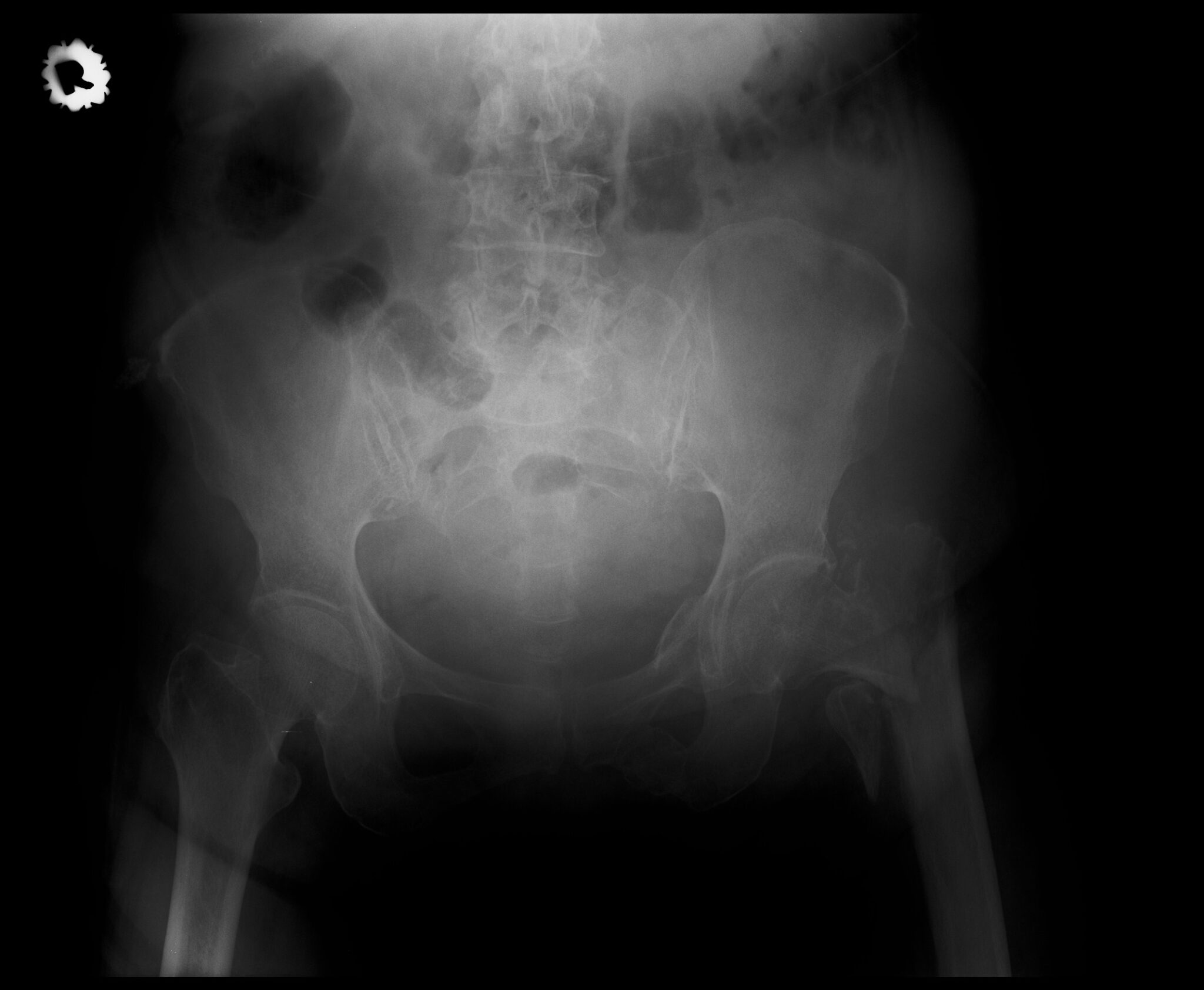 closed-fracture-of-left-neck-of-femur-uni-clinic